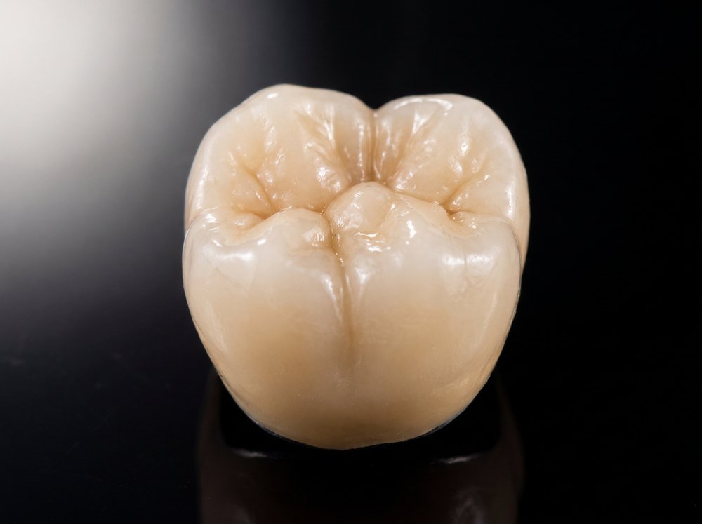 Corona metal-cerámica — trabajo del laboratorio Keramik Studio