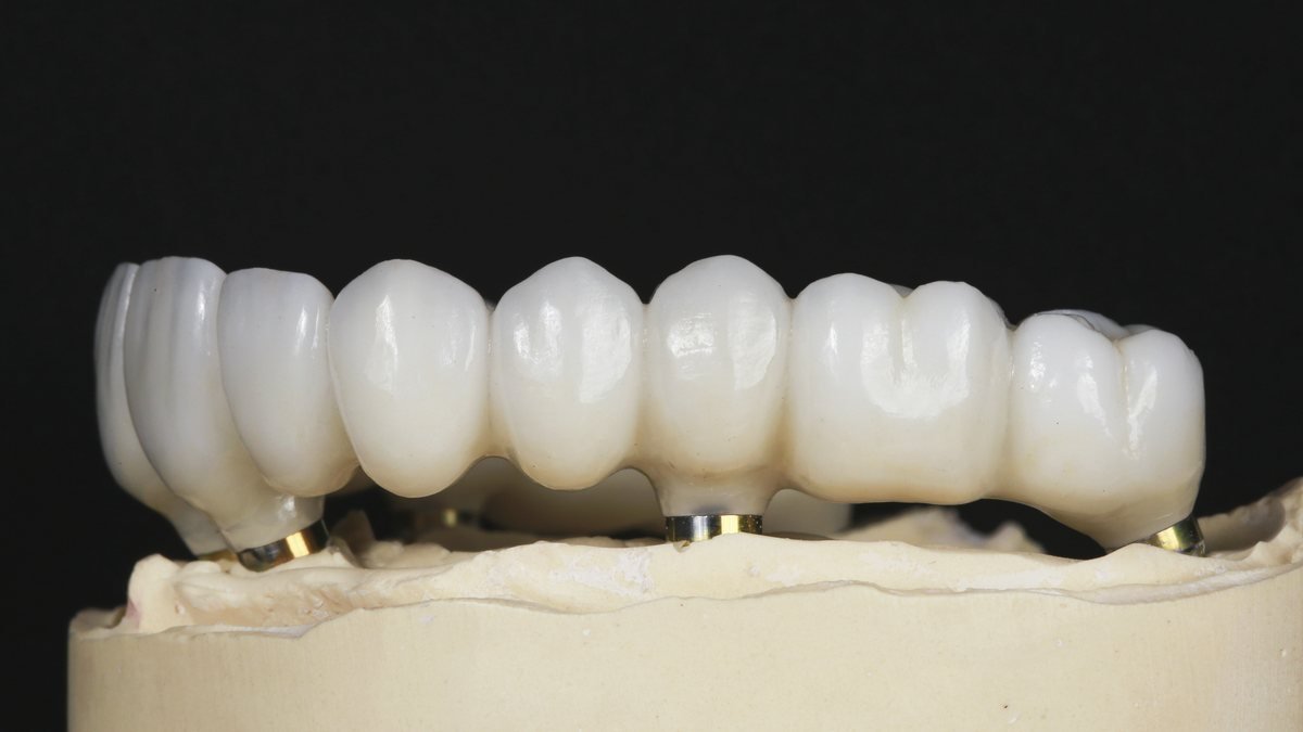 Puente completo de zirconio sobre implantes montado en su modelo de trabajo
